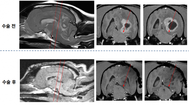 수술 후 영상에서 종양이 제거된 것이 확인되며, 종양에 의해 발생했던 뇌간 압박이 해소된 모습